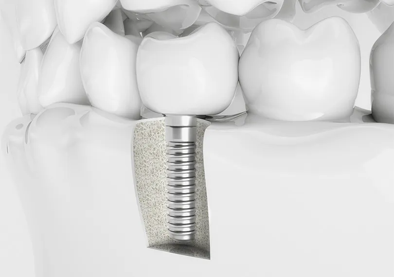 임플란트 (Implant) — 인공 치근을 식립해 씹는 기능과 심미성 회복을 돕는 진료